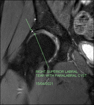 Complete Resolution of Extensive Labral tear and Para-labral Cysts on ...