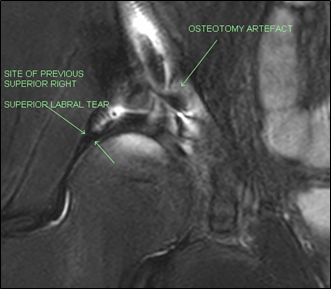 Complete Resolution of Extensive Labral tear and Para-labral Cysts on ...