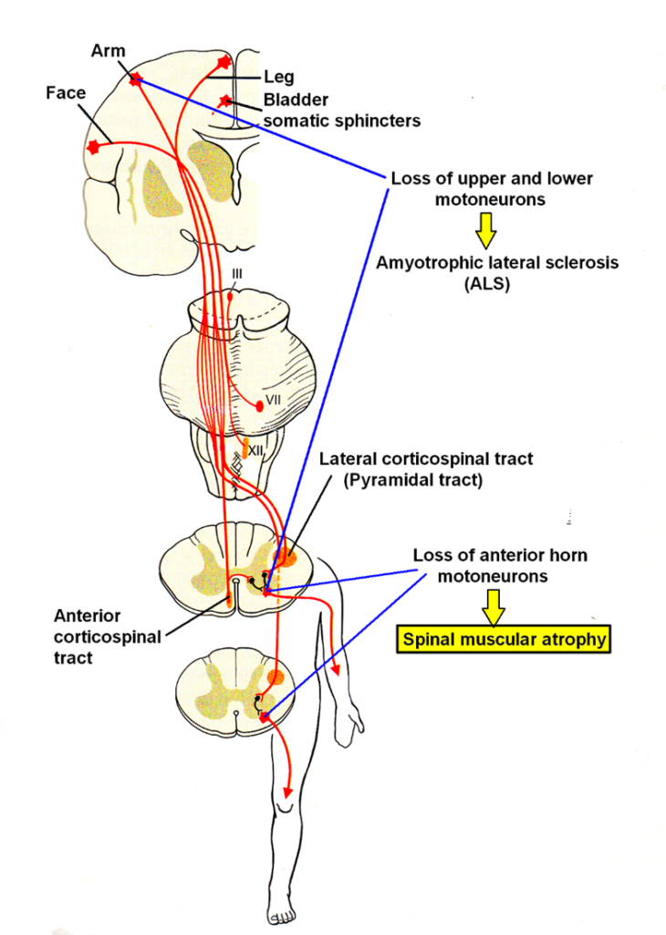 Spinal Muscular Atrophy Repair through Coordination Dynamics Therapy ...