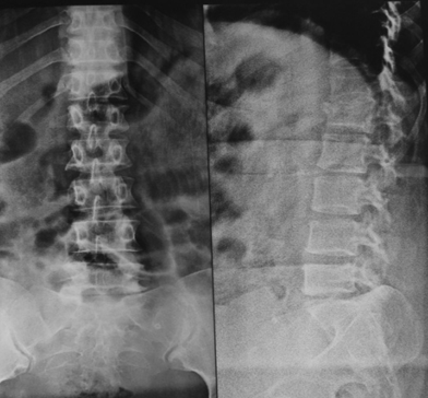 Impact of Timing and Surgical Decompression with Posterior ...